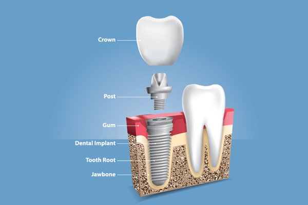 Dental Implants